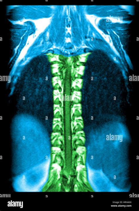 MRI of Normal Thoracic Spinal Cord Stock Photo - Alamy