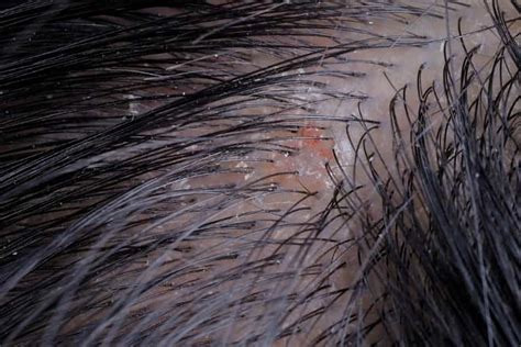 Scabs and Sores on Scalp: 17 Causes, Pictures and Treatment