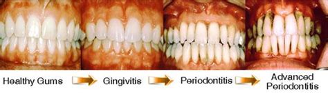 Stages of Gum Disease (Periodontitis): Maritza O Jenkins, DMD: General Dentist