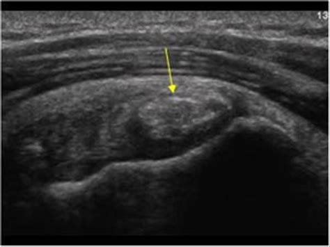 Musculoskeletal Joints and Tendons | 6.1 Shoulder : Case 6.1.18 Bursa: Calcific bursitis ...