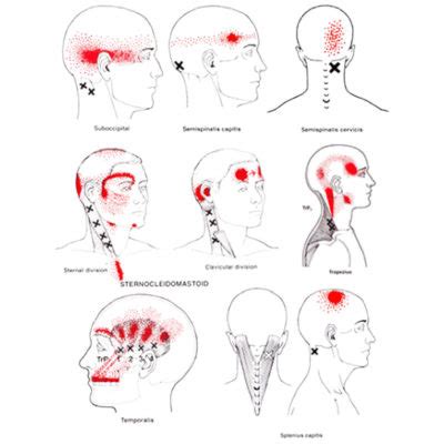 Headaches and Neck Pain or Cervicogenic Headache