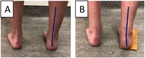 Subtle Cavovarus Foot: Ein übersehener Risikofaktor für chronische Fuß- und ...