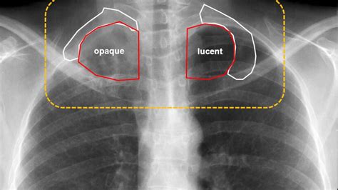 Pancoast Tumor Pictures Images and Photos - Pancoast Tumor of the Lung - YouTube