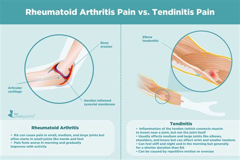 Causes of Rheumatoid Arthritis Pain Aside from Inflammation