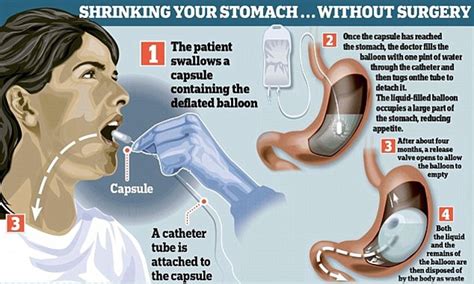 Gas-filled gastric balloon 'helps obese patients lose TWICE as much ...