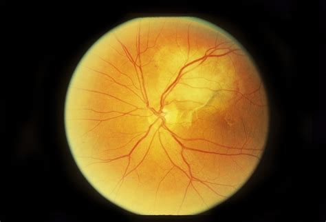 Paracentral Blind Spot And Scotoma - Retina Image Bank