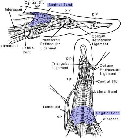 Sagittal Band Rupture - Hand - Orthobullets