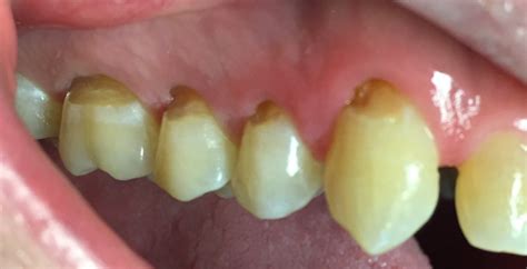 root caries | Dr. Gentry