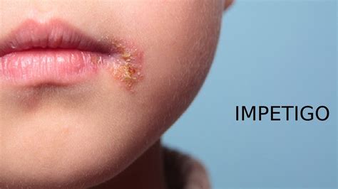 Impetigo in children - Causes, Symptoms, Diagnosis & Treatment