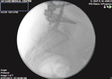 Epidural Lysis of Adhesions: Percutaneous and Endoscopic Techniques | Radiology Key