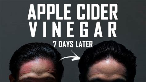 Scalp psoriasis home remedy with APPLE CIDER VINEGAR - YouTube