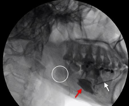 Extravasation of the contrast agent (red arrow) following sub-... | Download Scientific Diagram