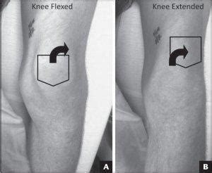 Knee Patella Instability – “J Sign” | Ashvin K Dewan, MD