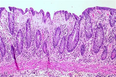 Collagenous Colitis: Causes, Symptoms & Treatment | Dr. Thind