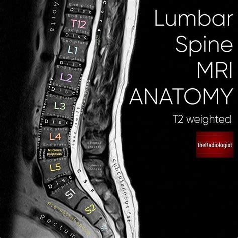 The Radiologist on Instagram: “Sagittal T2 weighted image of an MRI of the lumbar spine ...