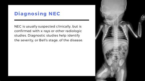 Necrotizing Enterocolitis (NEC) in Premature Babies