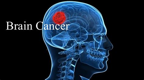 Brain Cancer Causes Treatmentsurvical Ratesymptomsstage