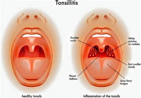 Symptoms of Tonsillitis fever - PT Master Guide | PT Master Guide