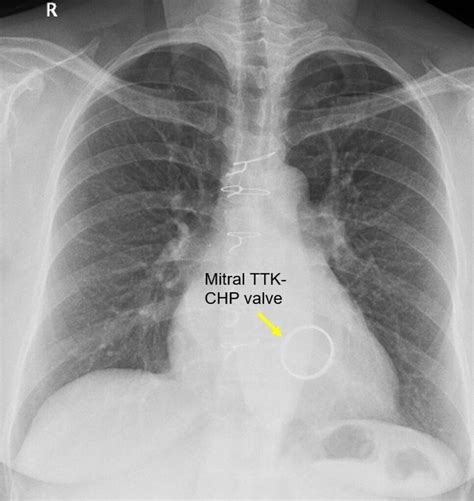 Mitral Valve Replacement Chest X Ray