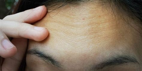 Forehead Wrinkles: 7 Ways to Get Rid of and Prevent Them