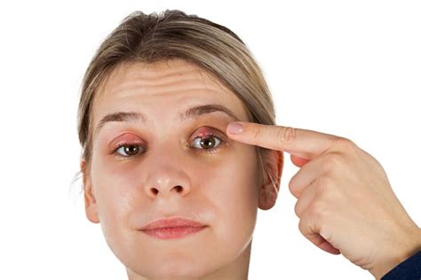 What Is a Stye and How Should You Deal with It?