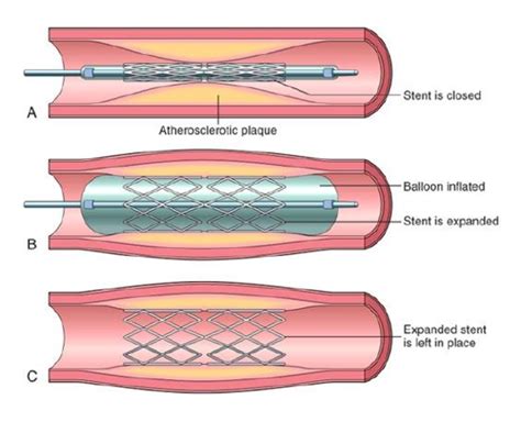 Angioplasty (PCI/PTCA) - Edmonton Cardiology Consultants