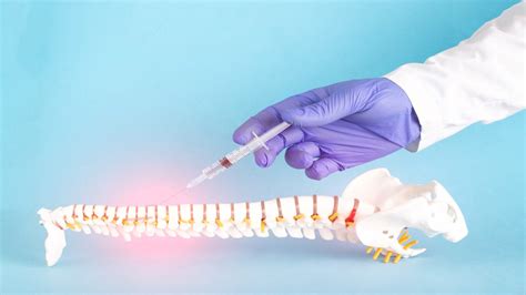 Facet Syndrome: Diagnosis and Treatment