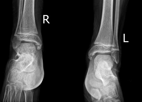 Medial Malleolus Ossification Center