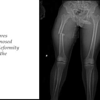 [PDF] Early application of the Thomas splint for femur shaft fractures ...