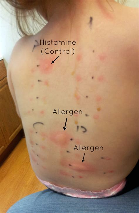 Skin Allergy Test | Nutrition Mission