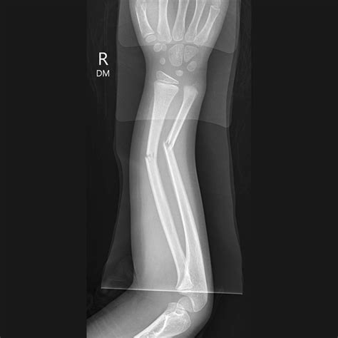 Images Of Greenstick Fracture / Huge collection, amazing choice, 100 ...