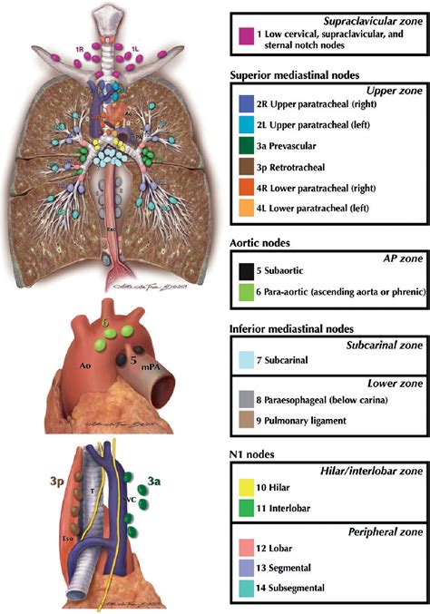 Figure 1 from Revised ESTS guidelines for preoperative mediastinal ...