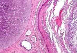 Most common type of teratoma of the testis is? - Surgery MCQ « PG Blazer