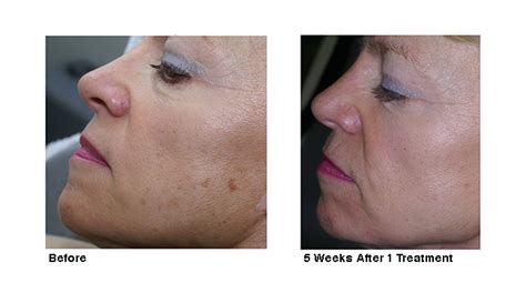 Removing Dark Spots on Face in Naperville | Naperville Age Spot Removal | Dark Spots on Face ...