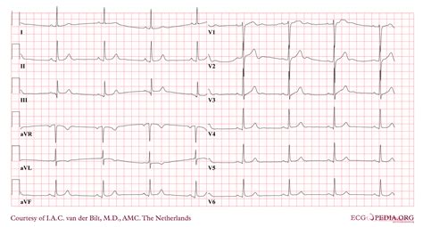 Asystole and Pulseless Electrical Activity (PEA) - MedCourse India