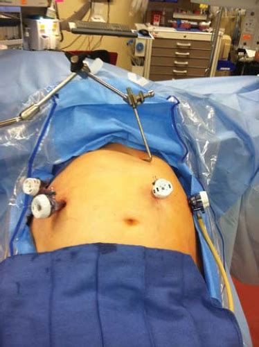 Laparoscopic Truncal Vagotomy with Antrectomy and Billroth II Reconstruction | Abdominal Key