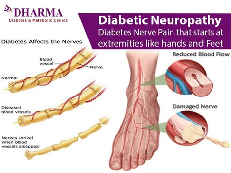 Lowering Blood Sugar: how to cure diabetic nerve pain in feet