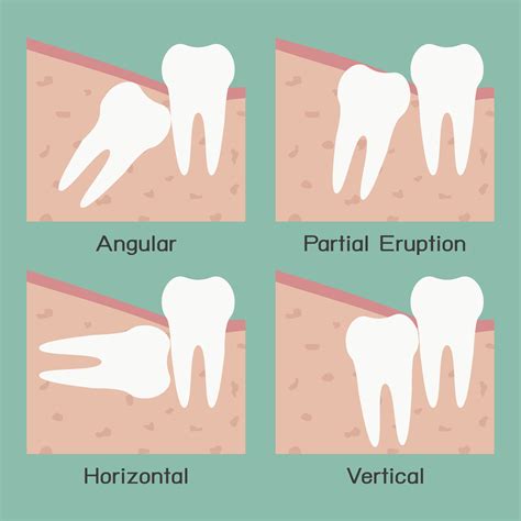 Wisdom Teeth Draper | Walter Meden