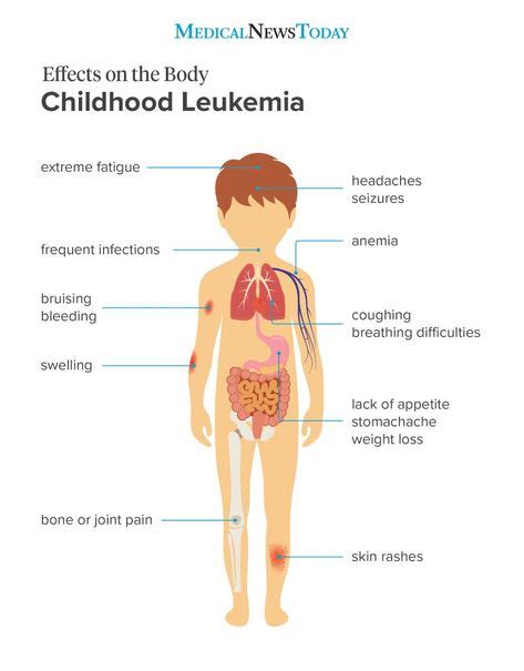 Effects on the body - childhood leukemia infographic | Childhood cancer ...