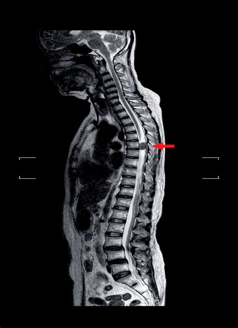 15+ Spinal Subluxation Treatment Home - KaighlaHavana