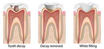 Difference Between A Dental Filling And A Dental Crown | Dentist ...