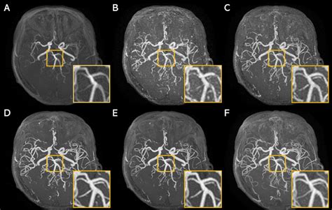 Super-resolution application of GAN on brain time-of-flight MR angiography | AI Blog