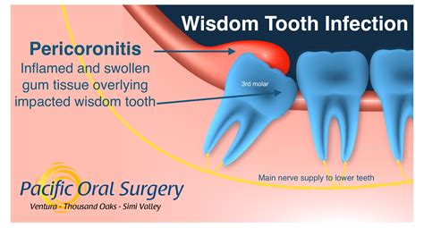 Wisdom Tooth Infection (Pericoronitis) in Ventura, CA - Pacific Oral ...