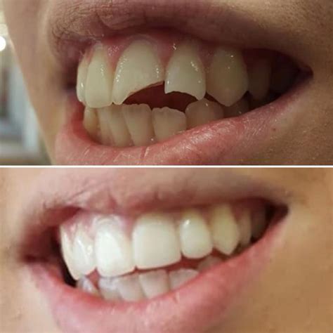 Broken Teeth Reconstruction, before and after - Brucegate Dental Practice