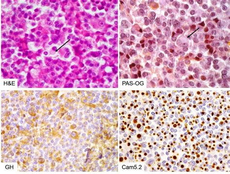 Pathology And Pathogenesis Of Pituitary Adenomas And Other Sellar ...