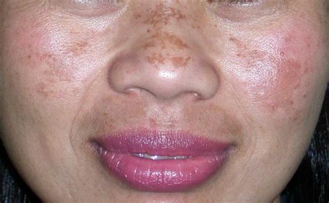 What is melasma? - Elegancy Beauty Bar