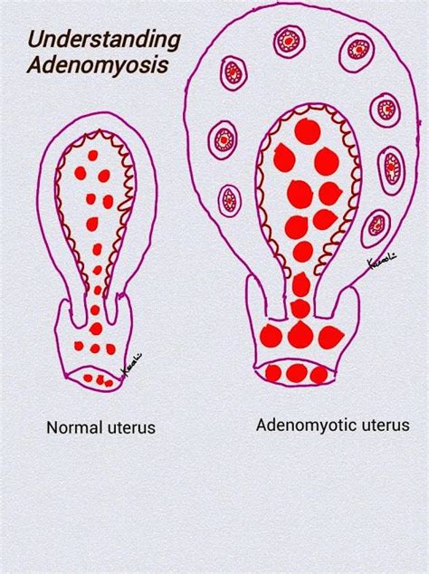 Adenomyosis | Endometriosis