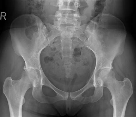 X-ray of Normal Pelvis (Female) | Eccles Health Sciences Library | J. Willard Marriott Digital ...