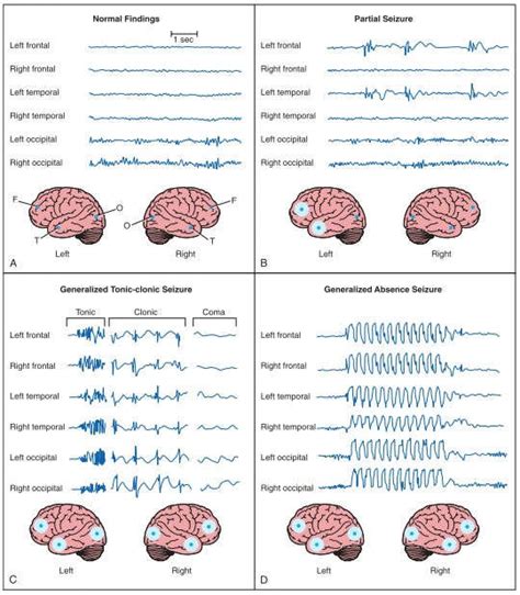 Pattern on EEG Fig.2 Patterns on electroencephalogram (EEG) in the... | Download Scientific Diagram