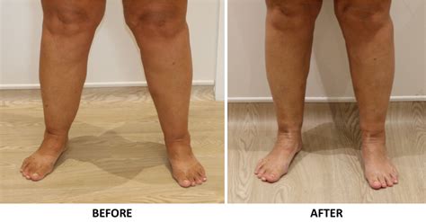 Ankle Contouring (Cankles) at The Karri Clinic